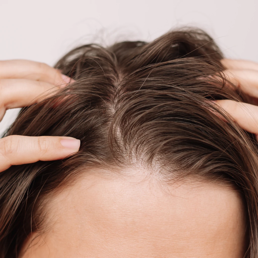 Acne no couro cabeludo