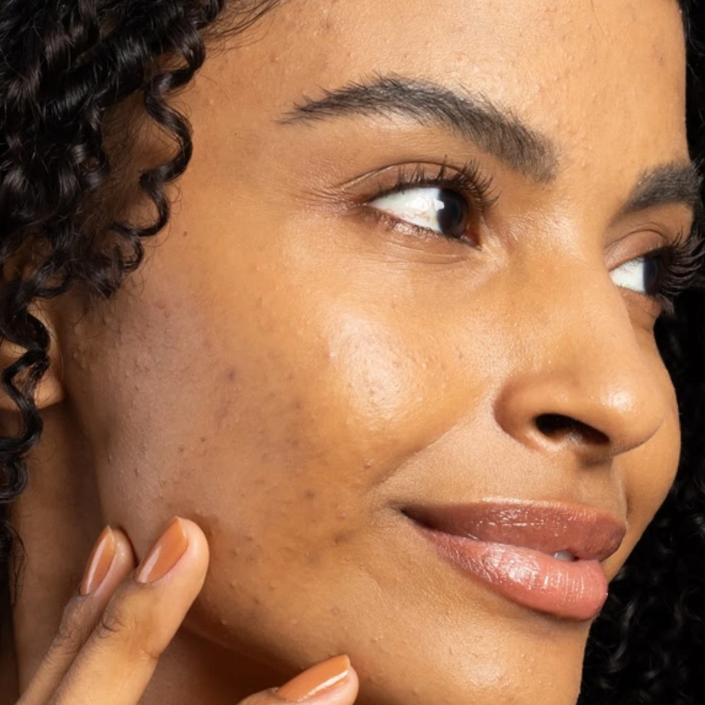 Acne e pele oleosa