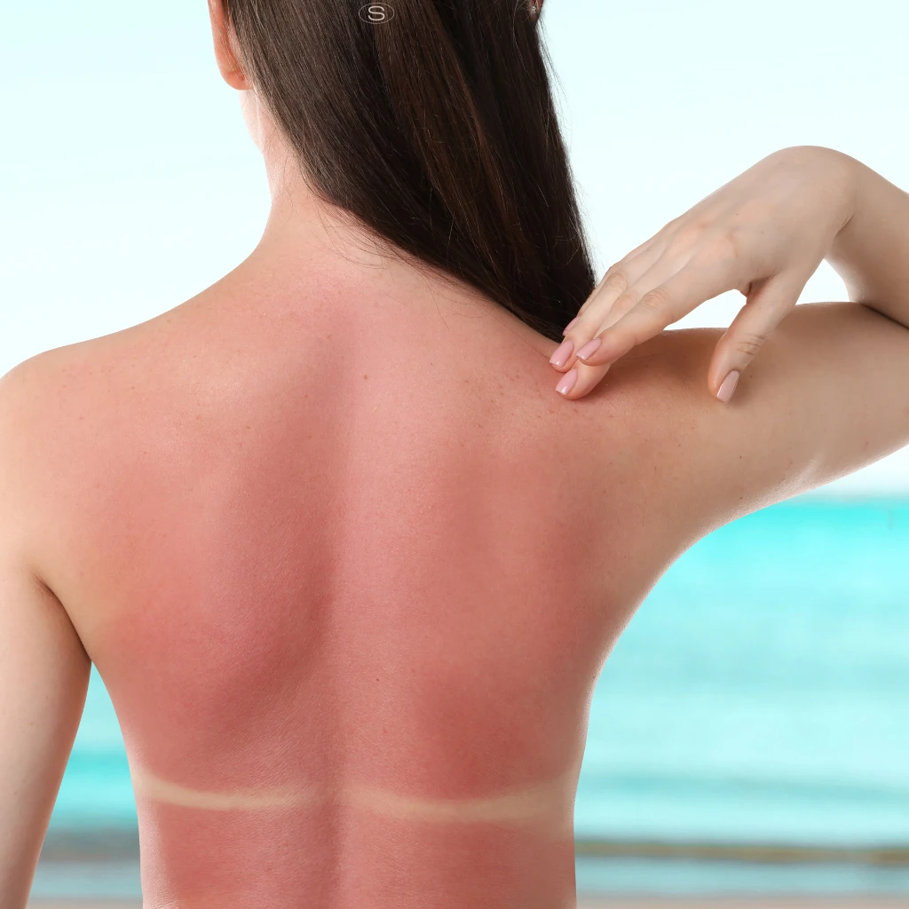 Envelhecimento da pele no verão